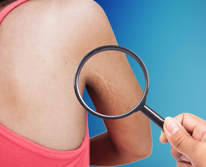 stretch marks health article