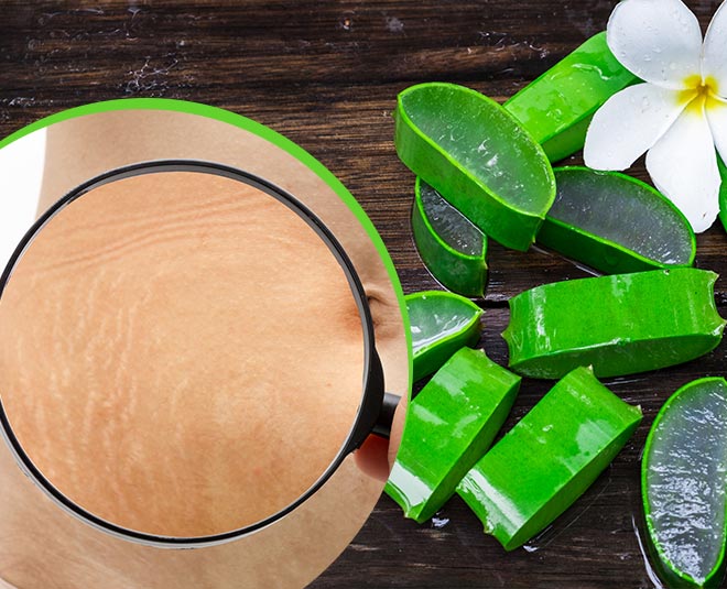 stretch marks health inside