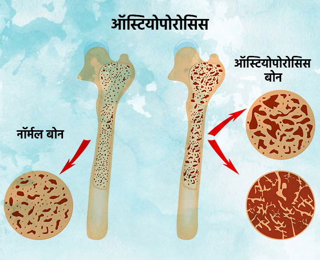 osteoporosis in woman inside