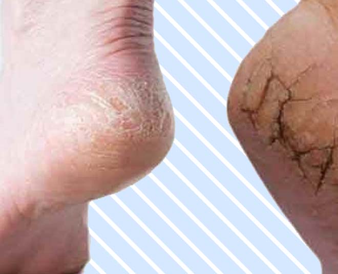 ankle pack to cure crackesd heels inside