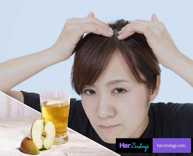 home remedies dandruff apple sirca