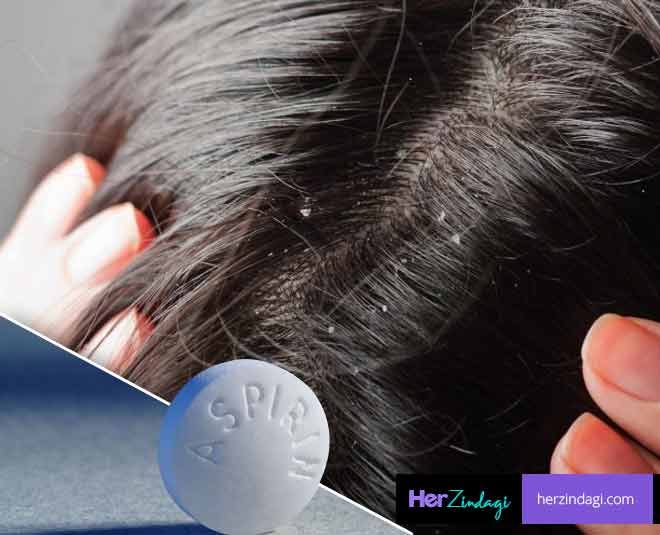 home remedies dandruff asprin