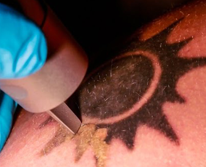 laser removal tattoo