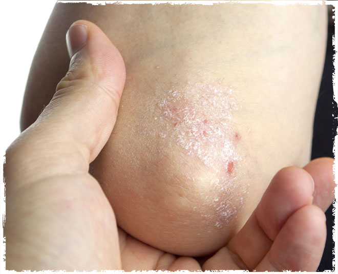 psoriasis problem inside