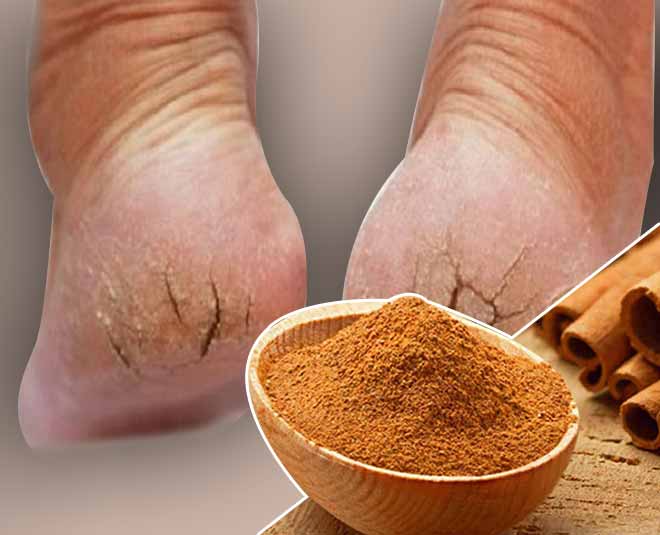 cinnamon beauty benefits crack heels