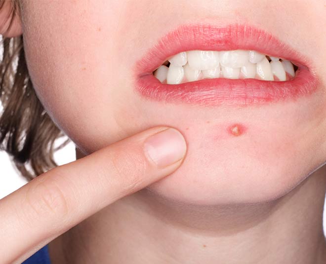 need an overnight cure for your acne Inside