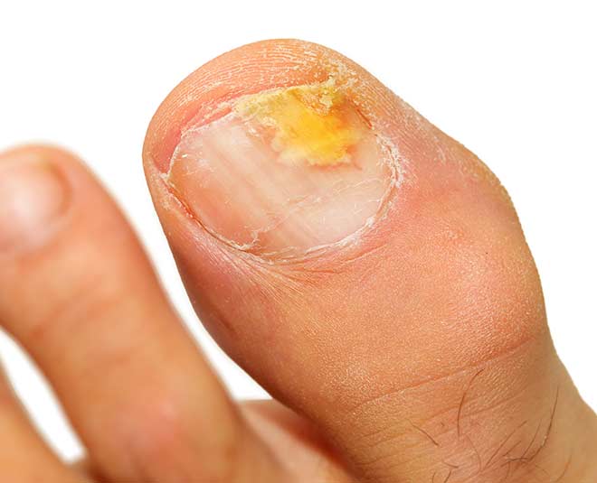 fungal infection health inside