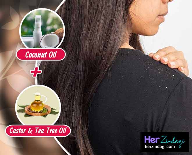 coconut oil home remedies dandruff