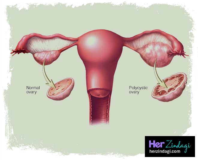 pcos condition inside