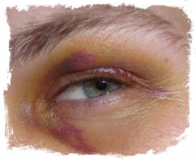 bruises on body inside