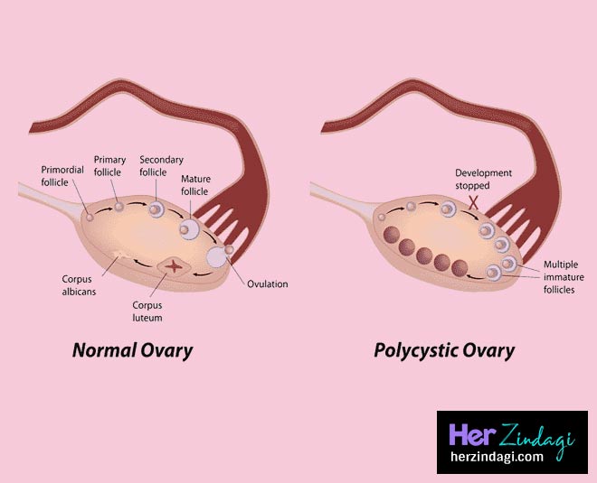 pcos health awarnessCARD ()