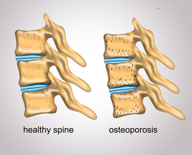 Osteoporosis spine inside