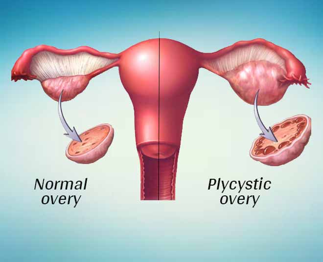 pcos problem depression inside
