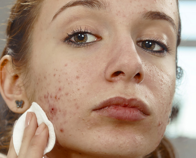 pimples pcos symtoms inside