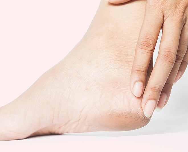 how to fix cracked heels permanently