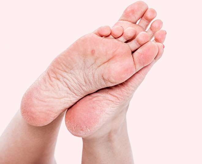 how to heal deep cracked heels