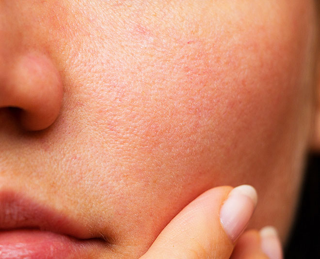 open pores remedy inside