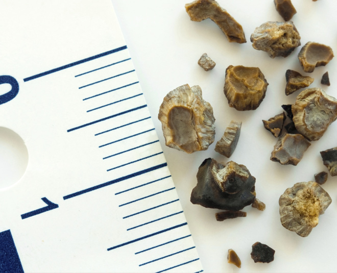 kidney stones turmeric