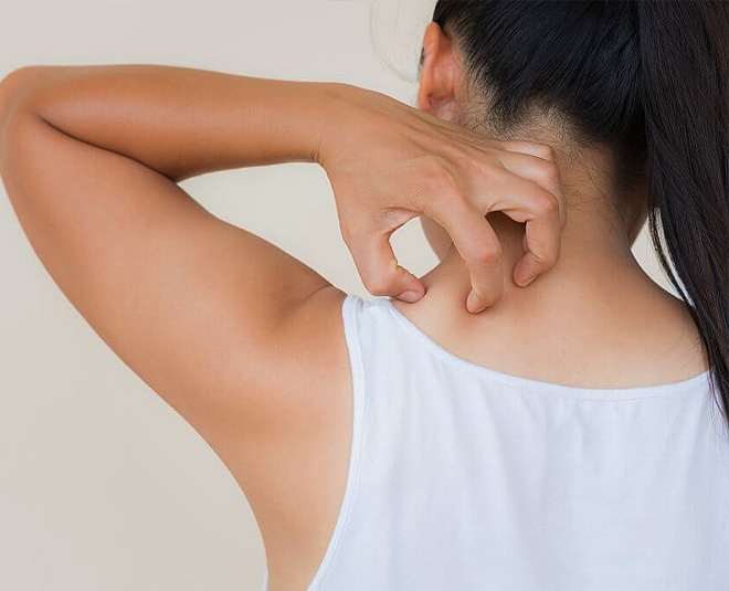 Mosquito Bite home remedies