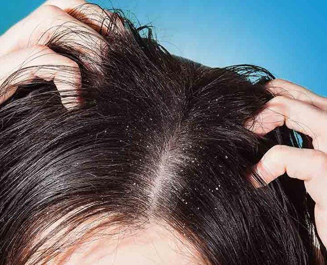 hair mask for dry scalp and dandruff homemade
