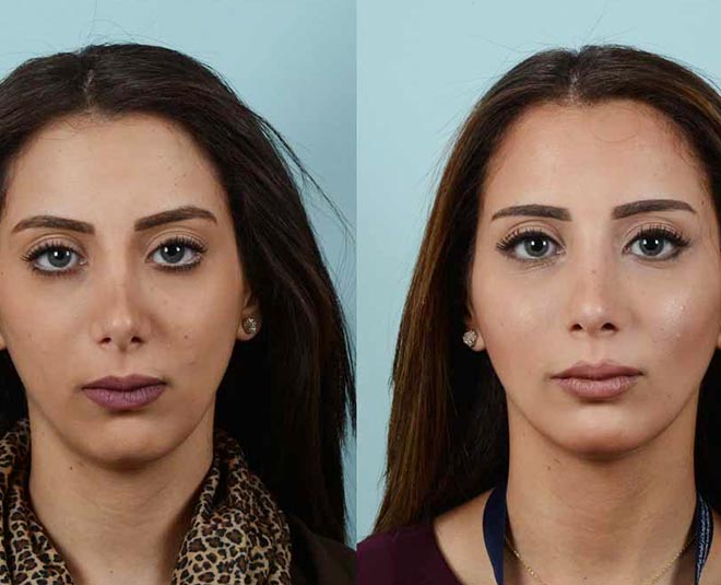 know benefits and side effects of rhinoplasty inside one