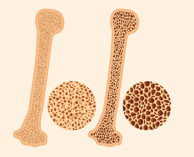 osteoporosis pathophysiology