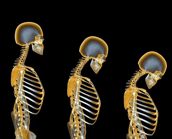 osteoporosis symptoms