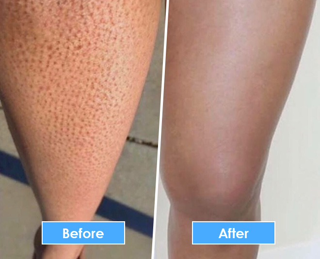 chemical peel for strawberry legs