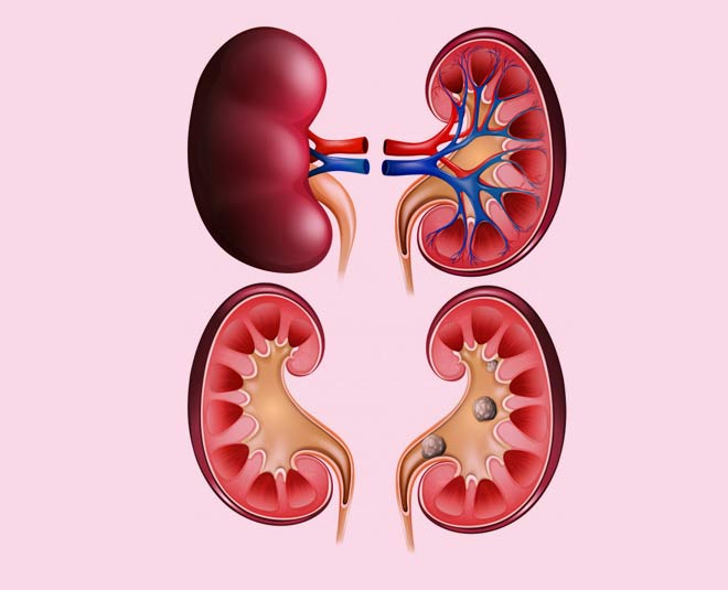 jamun vinegar kidney stone inside