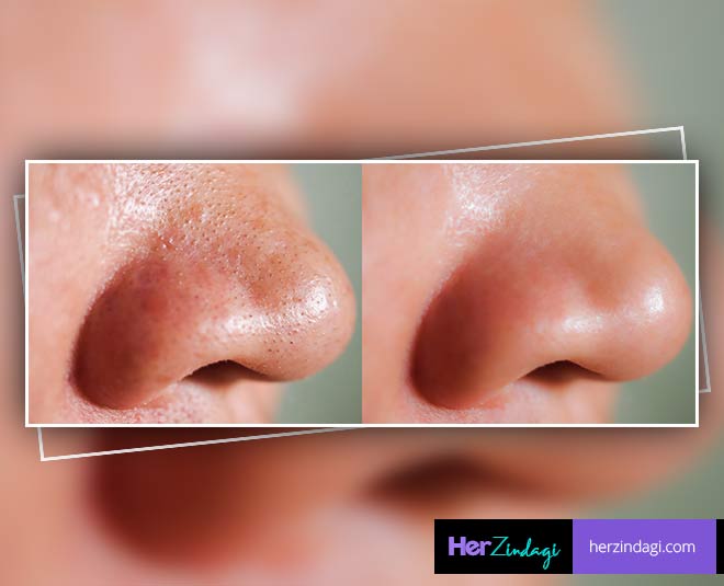 blackhead and its tricks