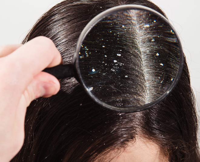dandruff pic