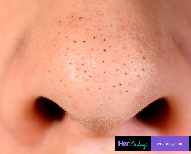 removing blackheads and tricks