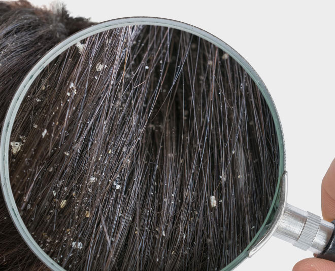 orange peel for dandruff