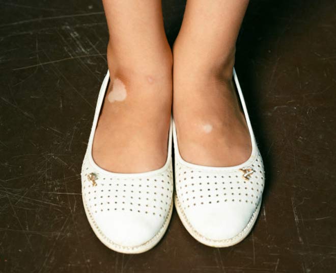 vitiligo problem inside