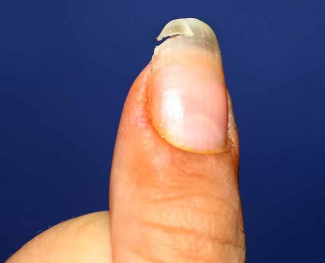 broken nails