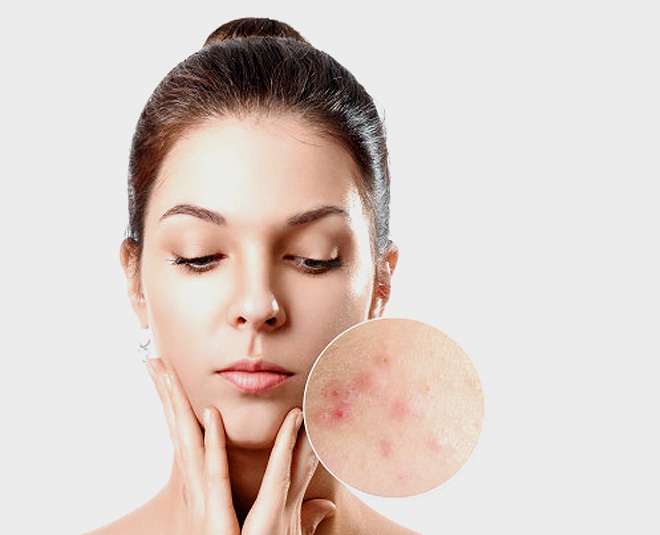 home remedies for acne scars overnight pic