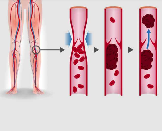 contraceptive side effects