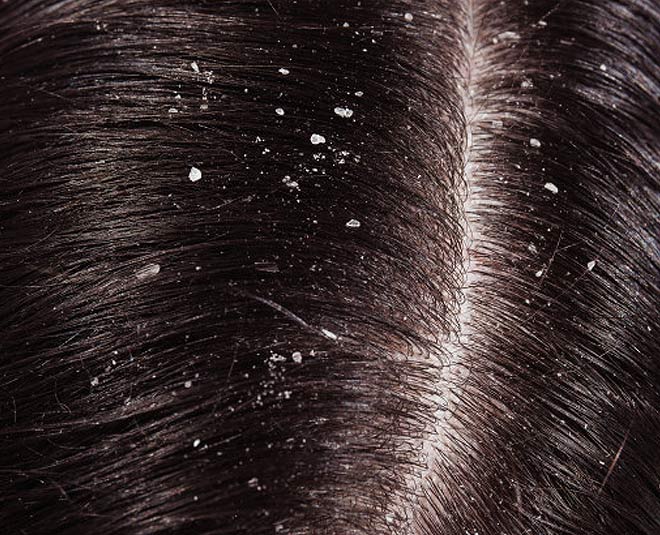 dandruff fungl infection