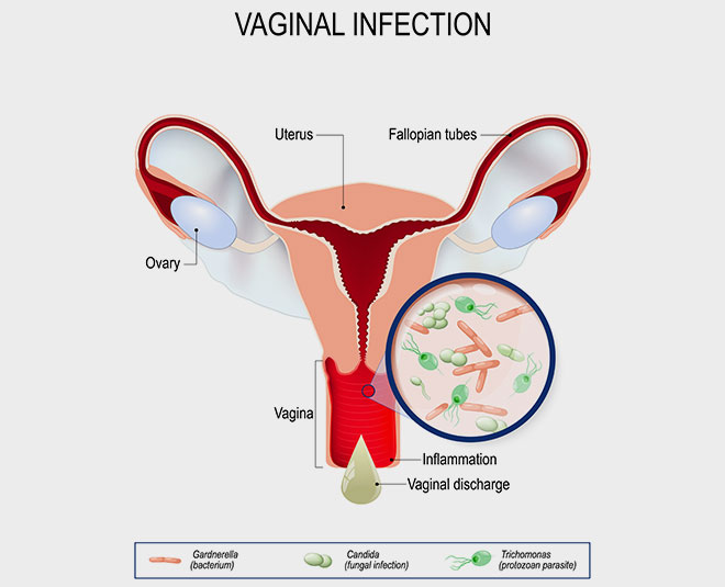 frequent yeast infections