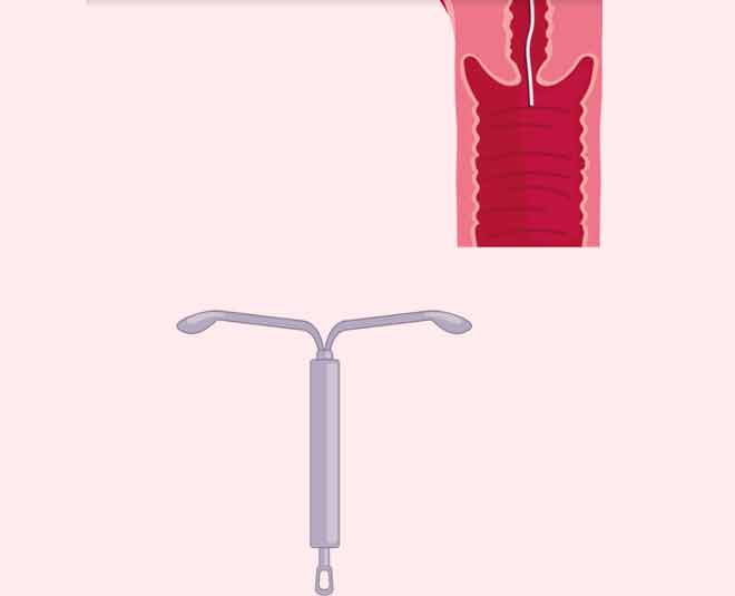iud birth control inside