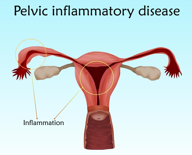 pelvic inflammatory disease reasons