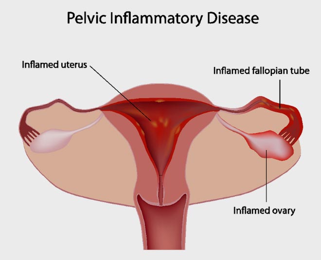 pelvic inflammatory disease symptoms