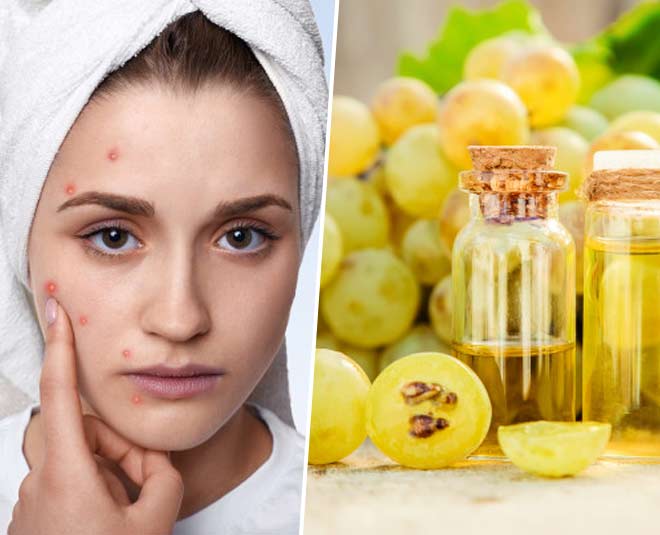 acne with grapeseedoil