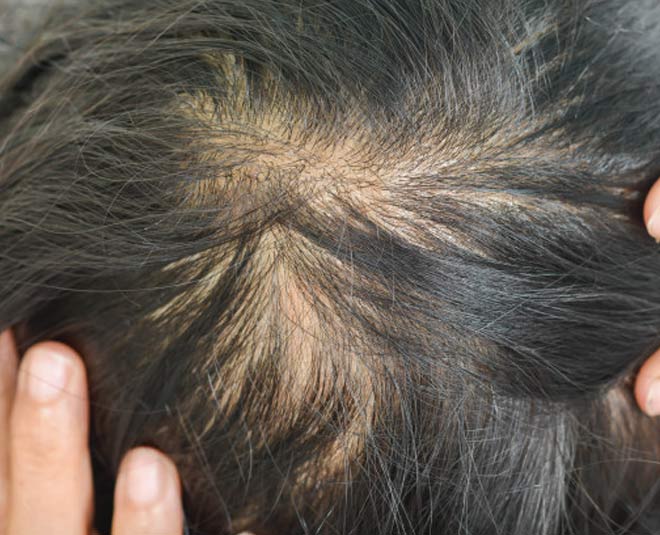 bald patches inside