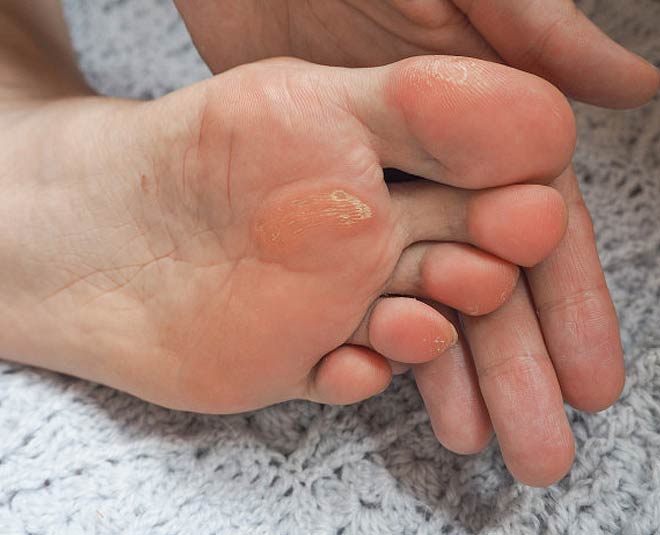 removing a foot corn