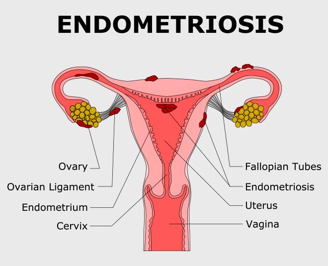 endometriosis during pregnancy