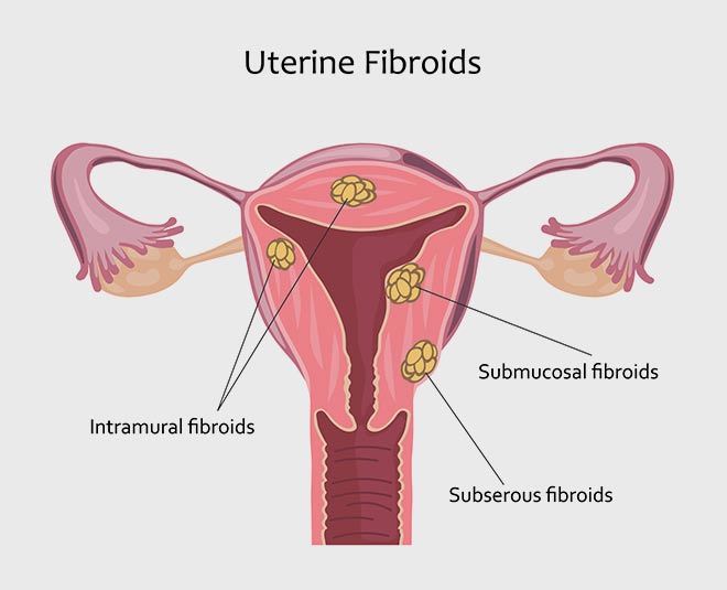 uterine fibroids