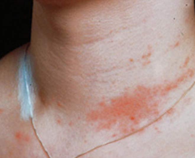 jewelery skin reaction