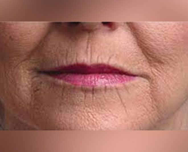 smoking wrinkles remedies inside