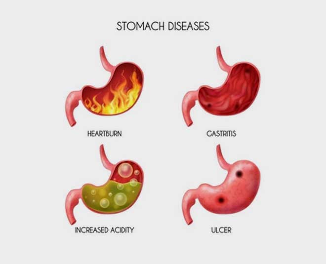 acid reflux